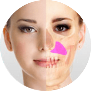 Facial Implant Surgery in Bangalore