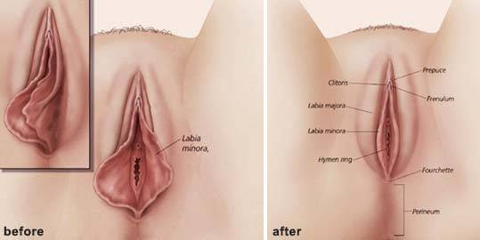 Labia Reduction Surgery in Bangalore