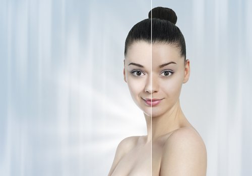 Laser Treatment for Skin Whitening, Age Spots & Sun Tan