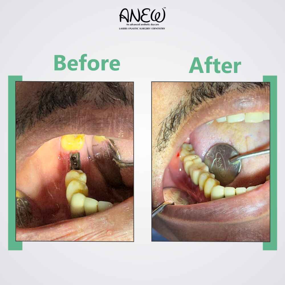 Basal Before and After image