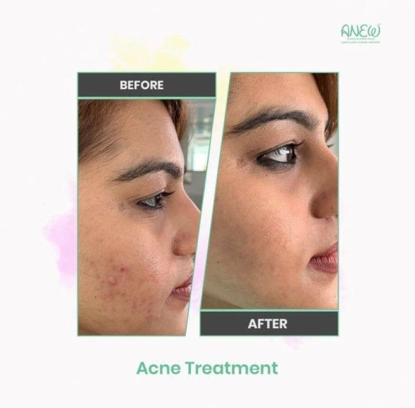 Acne Treatment