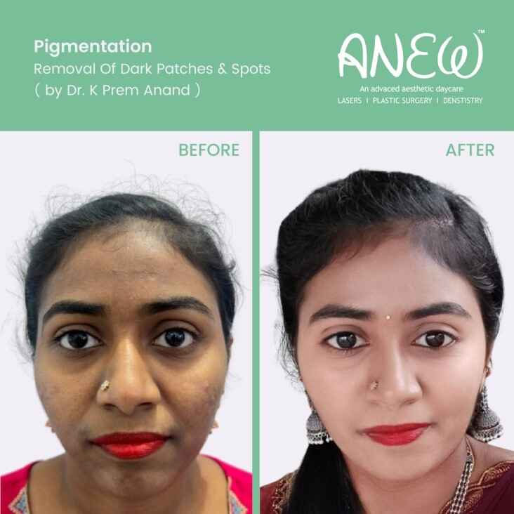 World’s leading professional depigmentation method – COSMELAN