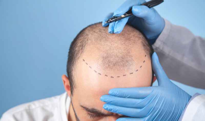 Most Trusted Hair Transplant Clinic in Bangalore