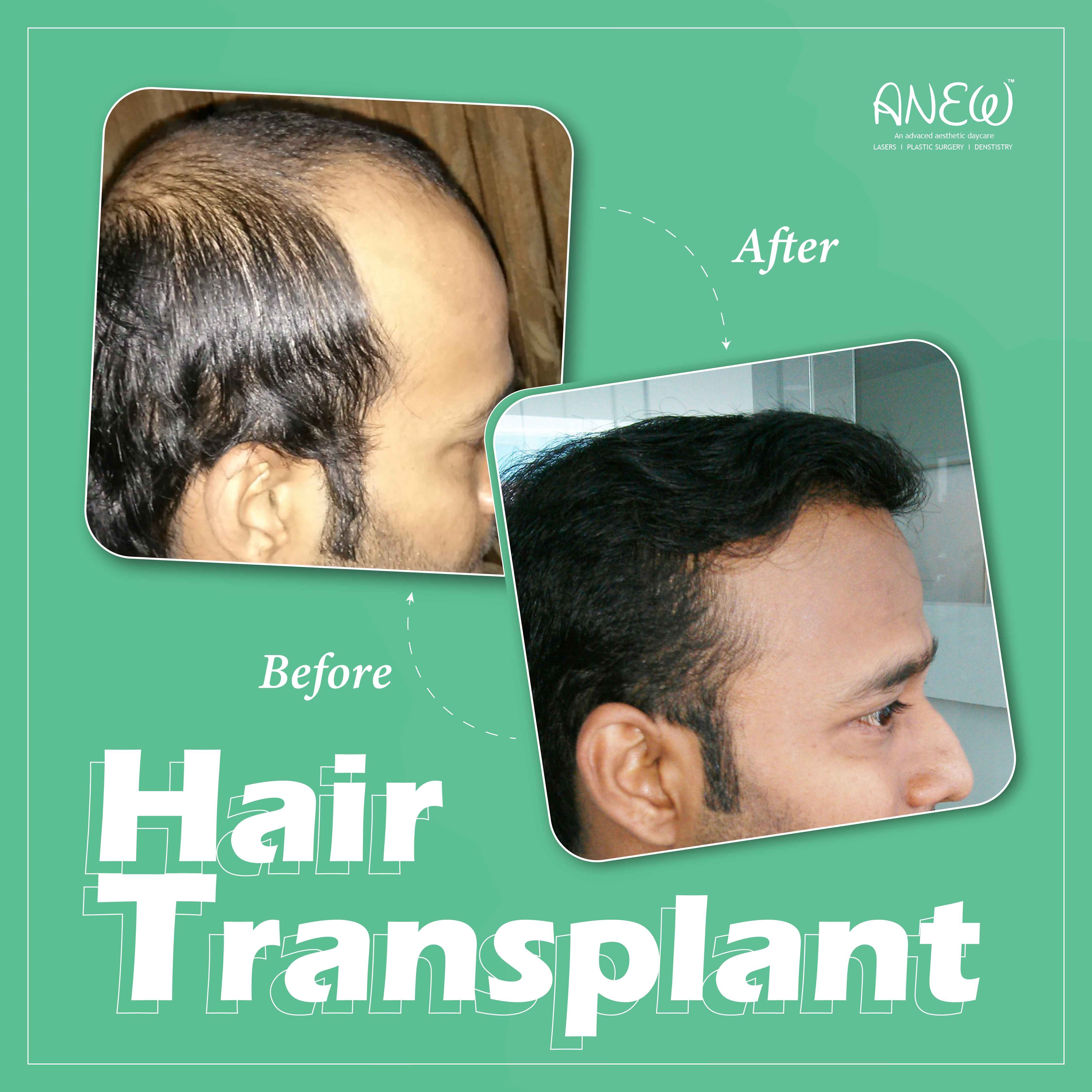 Most Trusted Hair Transplant Clinic in Bangalore