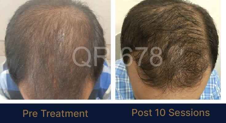 Best QR 678 Treatment in Bangalore