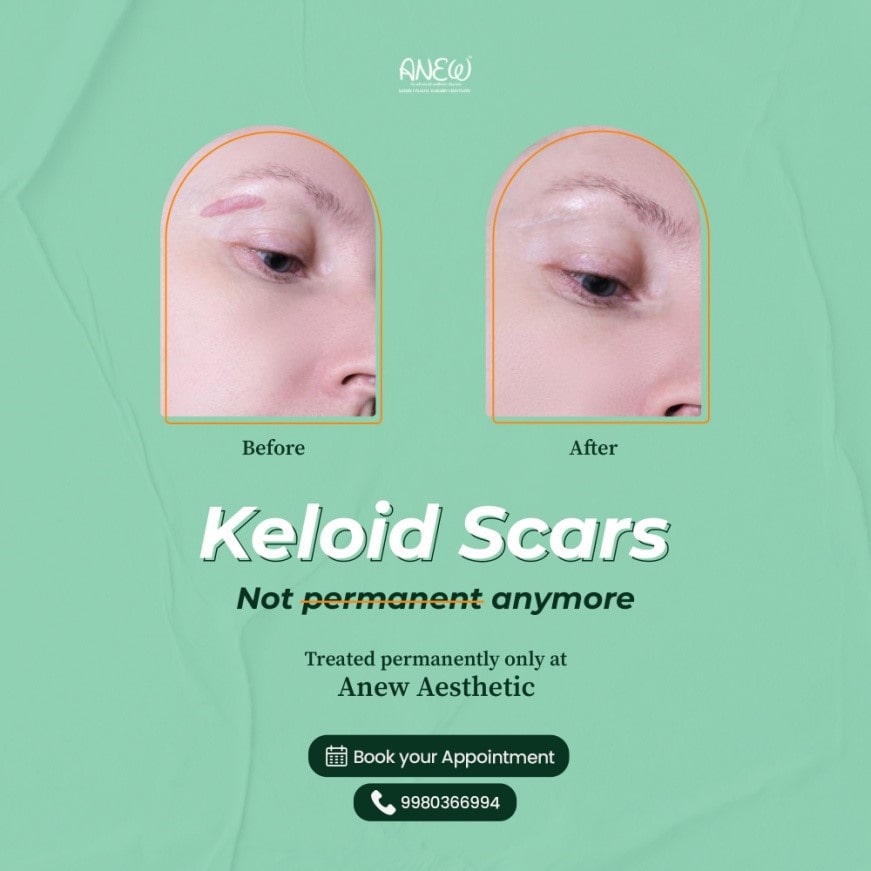 Keloid Scars Before and After Image