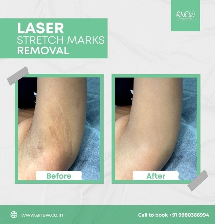 Laser Stretch Mark Removal in Bangalore