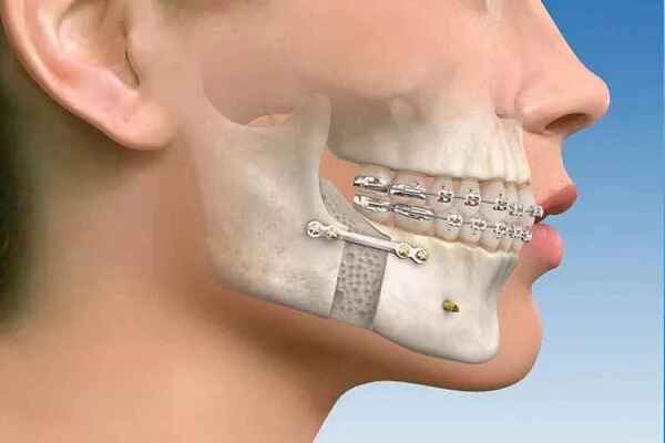 Mandibular Fractures