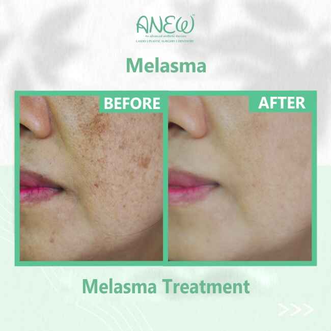 Melasma Treatment