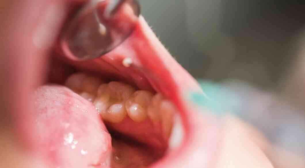 Oral Cancers