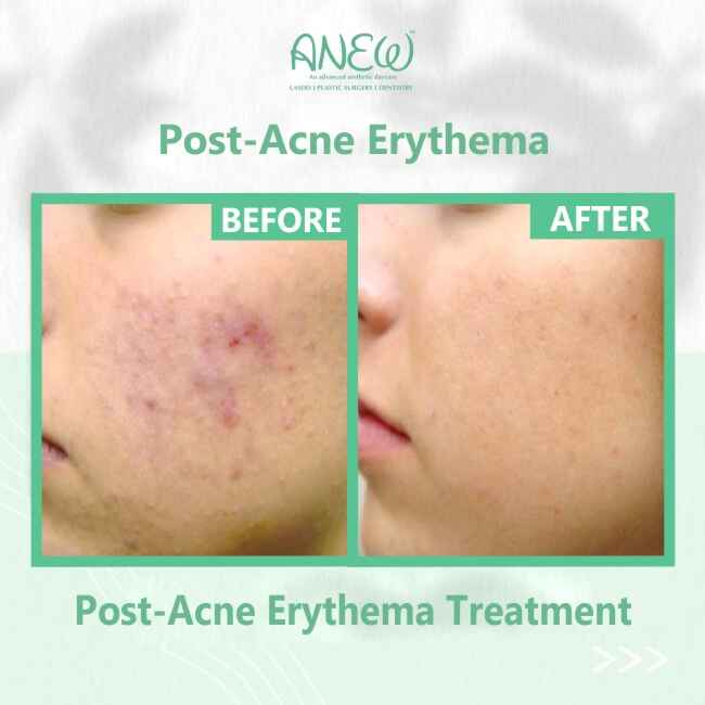 Post-Acne Erythemy Treatment