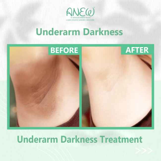 Underarm Darkness Treatment